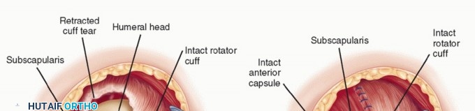 Illustration 22 for Subscapularis & Teres Rotator Cuff Repair: Advanced Techniques