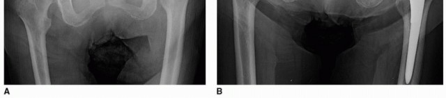 Illustration 12 for Mastering The Uncemented Socket: Ensure Lasting Hip Fixation