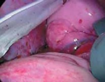 Illustration 31 for Mastering Anterior Interbody Arthrodesis with Instrumentation for Scoliosis