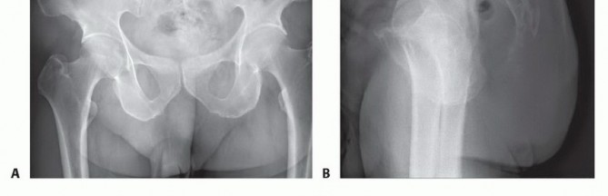 Illustration 15 for Sacral Tumor Surgery: Safeguarding Bowel & Bladder Control