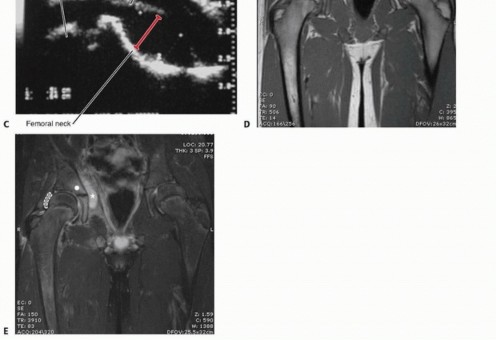 Illustration 5 for Septic Hip in Children: Mastering Anterior Drainage for Optimal Recovery