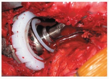 Mastering Component Removal: Extended Trochanteric Osteotomy