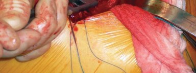 Illustration 7 for Cemented Femoral Stem Figures: Surgical Anatomy & Placement