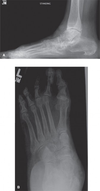 Illustration 2 for Foot & Ankle Pain: When radiographs are obtained, what do they reveal?