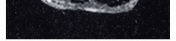 Illustration 15 for Above-Elbow & Below-Elbow Amputations: When & Why They're Needed