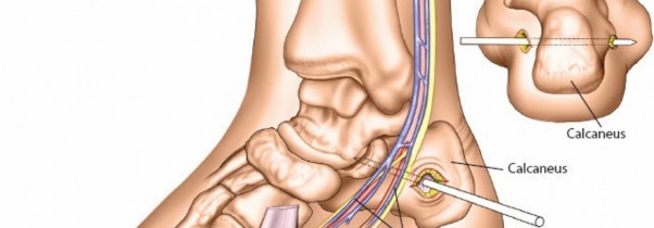 Illustration 40 for Key Approaches for External Fixation: Humerus, Radius, Ulna, Wrist