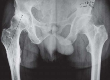 Illustration 4 for Metal on Metal Resurfacing: Enhanced Posterior Soft Tissue Repair