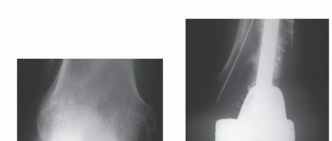 Illustration 26 for Avoid Major Surgery: Bone Tumor Treatment with Liquid Nitrogen Pour