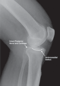 Illustration 2 for Knee Arthroplasty Unicondylar: Discover if Partial Knee Replacement is Right