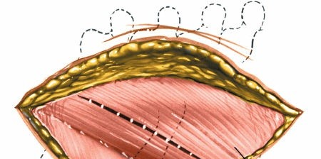 Illustration 292 for Approach to the Lumbar Spine: Mastering Techniques & Anatomy