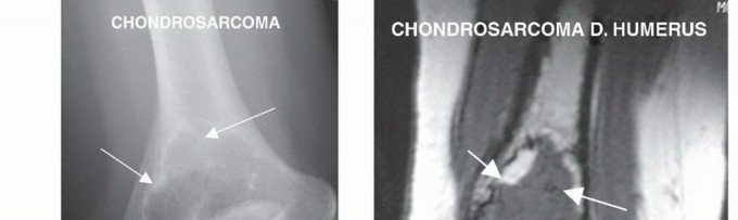 Illustration 4 for Distal Humeral Resection: Safe Techniques for Limb Preservation