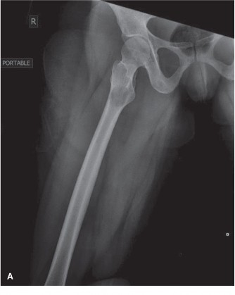 Mastering Oncology Cases: Multiple Myeloma & Bone Scan Nuances