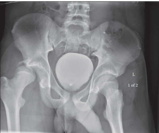 Illustration of hip posterior dislocation - Dr. Mohammed Hutaif