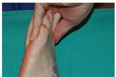 Illustration 23 for Restore Movement: Tendon Transfer for Common Peroneal Nerve Foot Drop