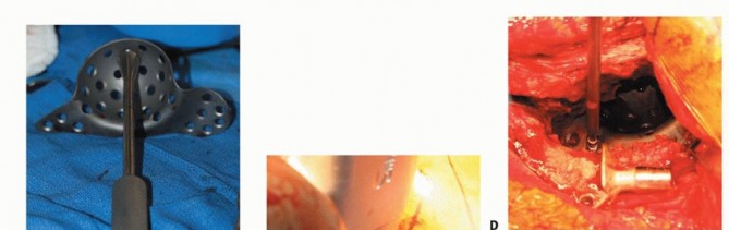 Illustration 14 for Revision Arthroplasty with Acetabular Bone Loss: The Antiprotrusio Cage