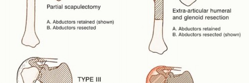 Illustration 8 for Limb-Sparing Resections Around the Shoulder: Optimizing Outcomes