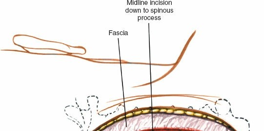 Illustration 173 for Approach to the Lumbar Spine: Mastering Techniques & Anatomy