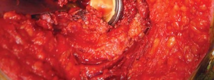 Illustration 25 for The Silent Hip: Achieving a Truly Silent, Pain-Free Joint