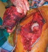 Illustration 35 for Advanced Arthroplasty for Malignant Lesions: Reclaim Your Mobility