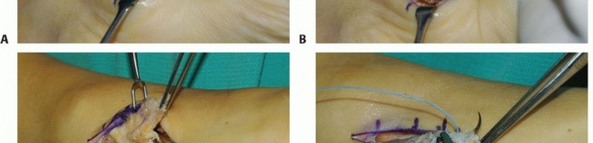 Illustration 6 for Restore Movement: Tendon Transfer for Common Peroneal Nerve Foot Drop