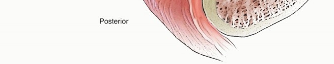 Illustration 35 for Restore Shoulder Function with Latissimus Dorsi Tendon Transfer