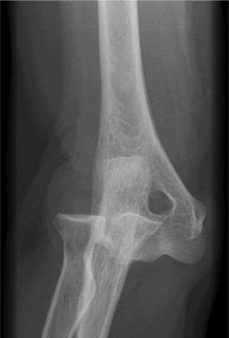 Illustration 64 for Right Shoulder Pain? Avoid This Common X-ray Mistake.