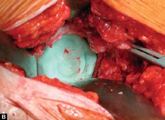 Illustration 18 for Optimizing Acetabular Component Cementation for Superior Outcomes