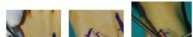 Illustration 2 for Mastering Midfoot Arthrodesis: Protect the Deep Neurovascular Bundle