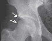 Illustration 36 for Resolving Femoral Head Neck Impingement: Arthroscopic FAI Solutions