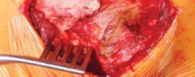 Illustration 4 for The Modified Hardinge Approach: Key Surgical Insights