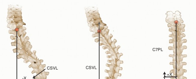 Illustration 7 for Adult Scoliosis: Uncover Causes & Find Lasting Back Pain Relief