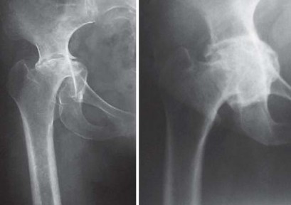 Illustration 8 for Total Hip Arthroplasty: Restoring Mobility in Juvenile Idiopathic Arthritis