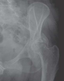 Illustration 16 for Navigating Early THA for Fractures of the Acetabulum