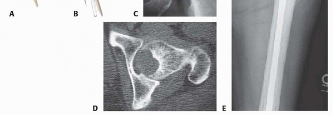 Illustration 9 for Regain Mobility: Total Hip Arthroplasty for Malignant Lesions