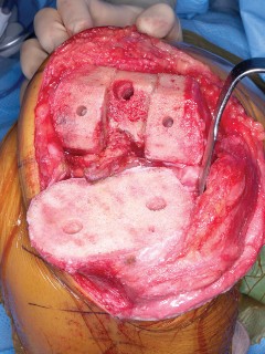 Illustration 19 for PROSTALAC Articulating Spacer: Treat Infected Knees, Regain Mobility