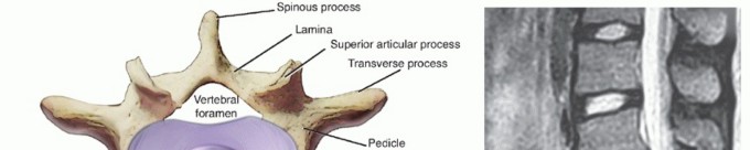 Anterior Lumbar Interbody: Fusion, Disc Replacement & Pain Relief