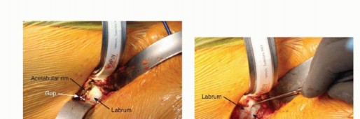 Illustration 27 for Anterior FAI Relief: Mini-Open Anterior Approach Explained