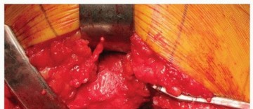 Illustration 22 for Uncemented Acetabular Revision: Optimizing Hemispherical Cup Use