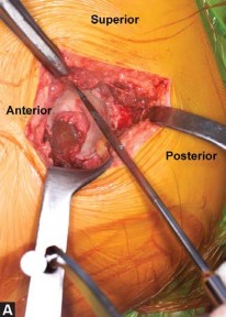 Illustration 15 for Avoiding Errors: Navigation in Total Hip Arthroplasty