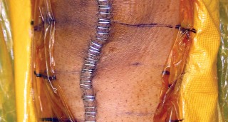 Illustration 18 for Monoblock Total Knee: When to Use & What to Avoid