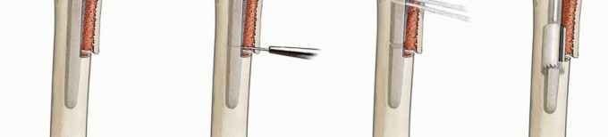 Illustration 16 for Well-Fixed THA Revisions: Precision in the Portion of the Osteotomy