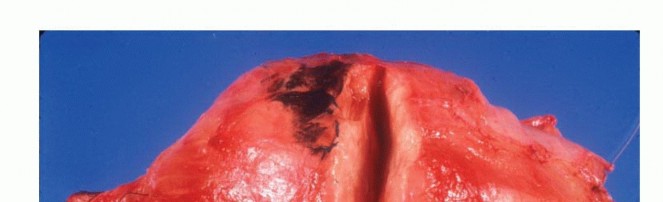 Illustration of biopsy of musculoskeletal - Dr. Mohammed Hutaif