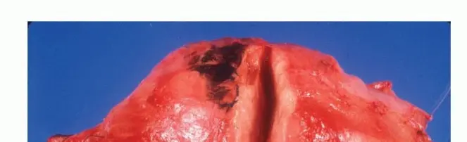 خزعة أورام الجهاز العضلي الهيكلي الدقيقة: مفتاح التشخيص السليم والعلاج الفعال في صنعاء مع الأستاذ الدكتور محمد هطيف