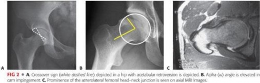 Illustration 54 for Mastering the Scope for Femoroacetabular Impingement