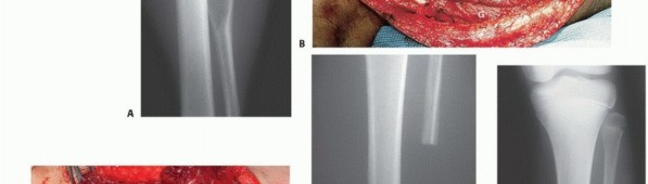 Illustration 31 for Beyond Amputation: The Type I Resection in Fibular Tumor Surgery