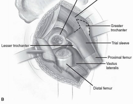 Illustration 10 for Recreate Hip Biomechanics: Modular Stems for Modular Solutions