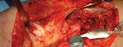 Illustration 73 for Femoral Stem Revision: Posterior Approach for Better Outcomes