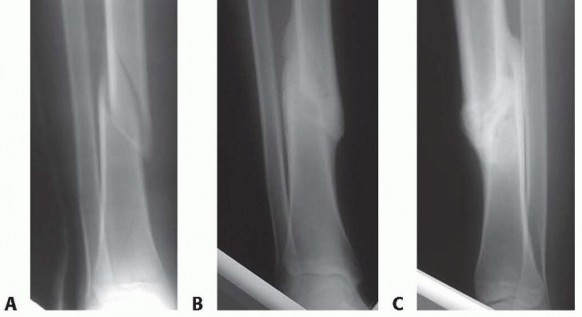 Illustration 5 for Advanced Nailing of the Mature Tibia: Overcoming Complexities