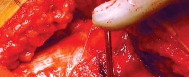 Illustration 24 for Posterolateral Surgical Approaches: Achieve Optimal Hip Replacement