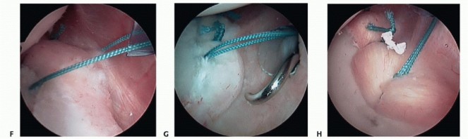 Illustration 9 for Mastering the Treatment of Recurrent Posterior Shoulder Instability